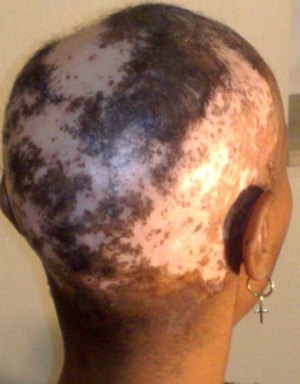 Scalp damage by a relaxer