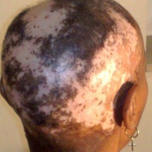 Scalp Damage by a relaxer