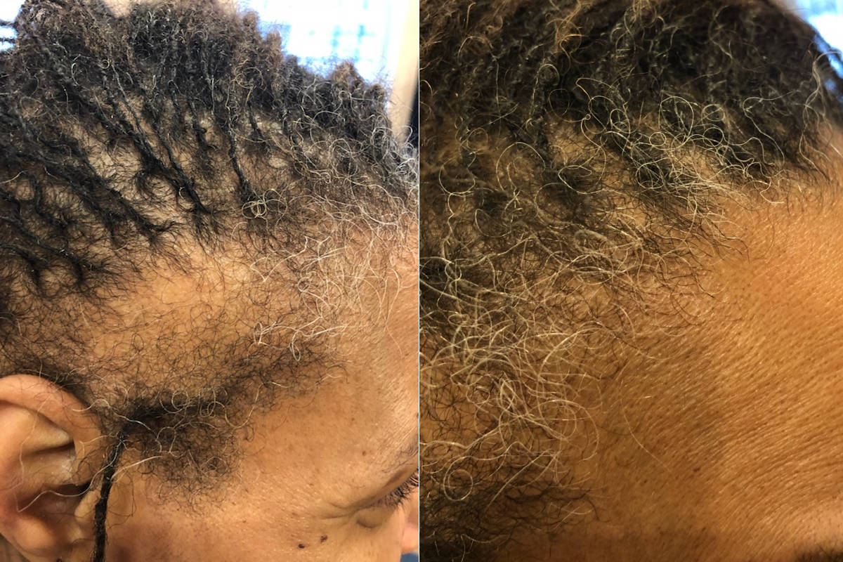 Tinekes hair growth Spray before after